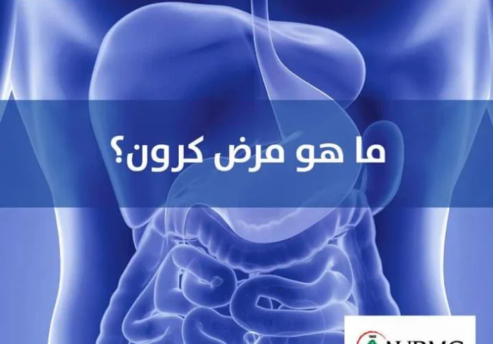 داء كرون الأسباب والأعراض والعلاج