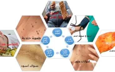 مقاومة الإنسولين هل هي مرض أم سبب المرض؟ 