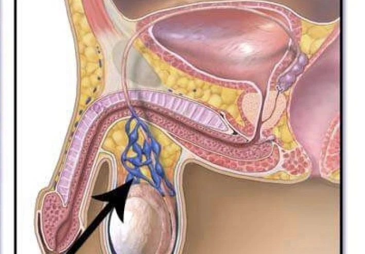 دوالي الخصية - Varicocele: السباب ، الاعراض ، طرق العلاج