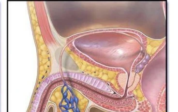 دوالي الخصية - Varicocele: السباب ، الاعراض ، طرق العلاج  