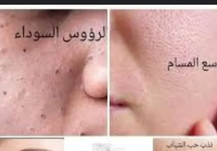 بشرتك مش احسن حاجه فيها حبوب تجاعيد تصبغات تعالي نشوف العلاج