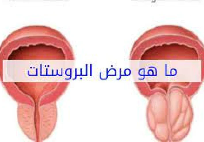 مسببات البروستات و طرق علاجها لدى الرجال