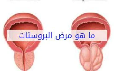 مسببات البروستات و طرق علاجها لدى الرجال