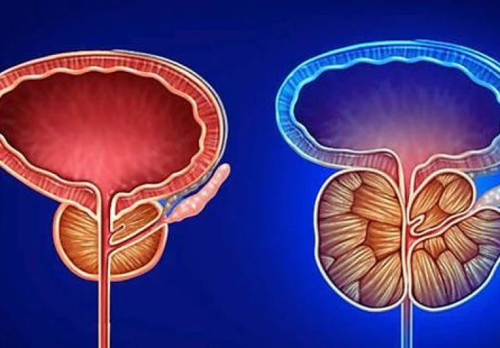Prostate Cancer: A Comprehensive Guide