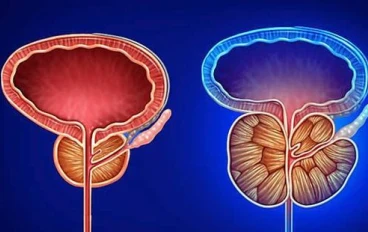 Prostate Cancer: A Comprehensive Guide