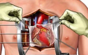 عملية قلب مفتوح لتغيير شرايين