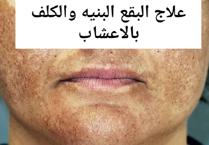 علاج البقع الجلدية والنمش بالاعشاب