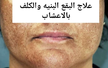  علاج البقع الجلدية والنمش بالاعشاب