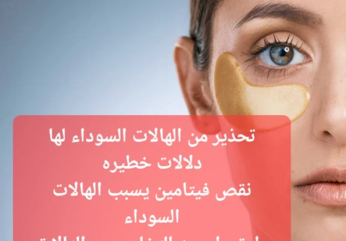 الهالات السوداء  أسبابها وكيفيه علاجها بالاعشاب