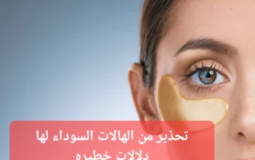 الهالات السوداء  أسبابها وكيفيه علاجها بالاعشاب 
