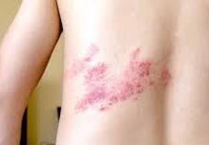 الحزام الناري (Herpes zoster / Shingles ): ما هو ؟ ، و ما هي اسبابه ؟