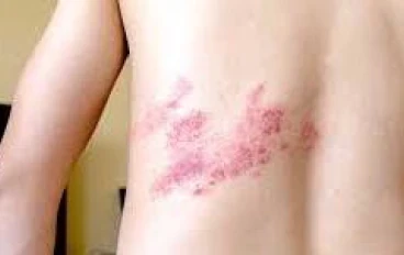 الحزام الناري (Herpes zoster / Shingles ): ما هو ؟ ، و ما هي اسبابه ؟ 