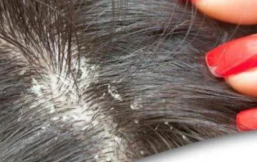 5 أطعمة لإنهاء معاناة قشرة الشعر.. طبيبة تقدم حلا سحريا
