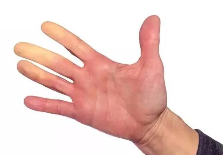 مرض رينود (راي- نوه) : ما هو ؟ ، و ما هي  أعراضه ؟
