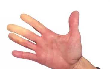 مرض رينود (راي- نوه) : ما هو ؟ ، و ما هي  أعراضه ؟ 