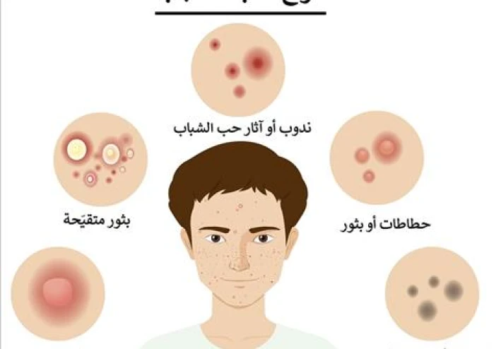 علاج الحبوب في الصيف: