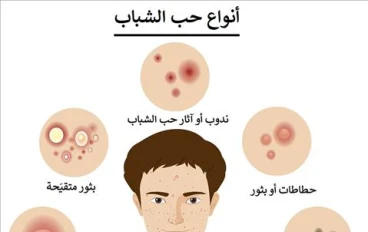 علاج الحبوب في الصيف: