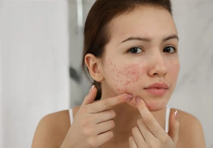 Acne: Causes, Treatments, and Prevention