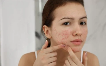 Acne: Causes, Treatments, and Prevention