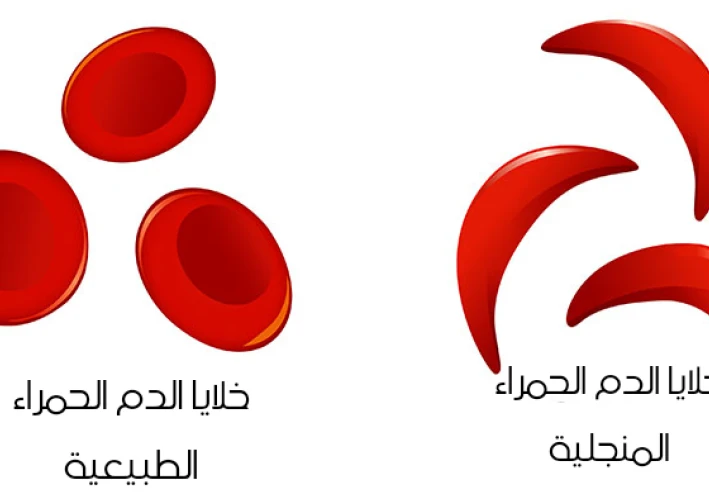 هل سمعت من قبل بخلايا الدم الحمراء  Red Blood Cells التي تشبه شكل الهلال او حرف C بالانجليزية؟؟