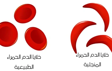 هل سمعت من قبل بخلايا الدم الحمراء  Red Blood Cells التي تشبه شكل الهلال او حرف C بالانجليزية؟؟
