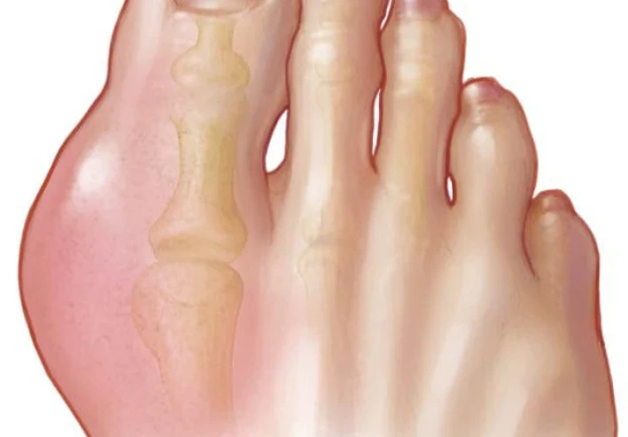 مرض النقرس (Gouty arthritis)  :  ما هو ؟ ، و ما هي أعراضه ؟ .