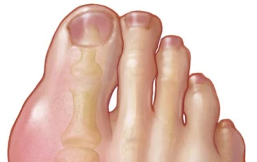 مرض النقرس (Gouty arthritis)  :  ما هو ؟ ، و ما هي أعراضه ؟ . 
