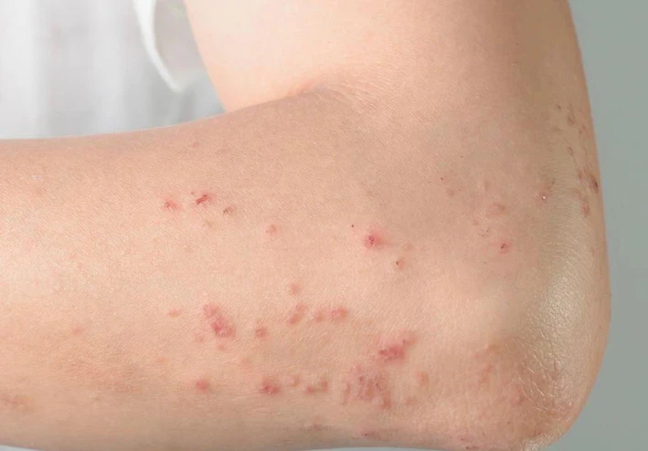 مرض بهجت  Behcet's syndrome : ما هو ؟ ، وما هي أعراضه ؟ .