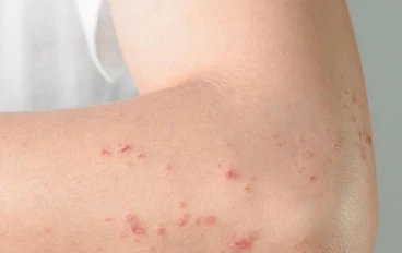 مرض بهجت  Behcet's syndrome : ما هو ؟ ، وما هي أعراضه ؟ . 