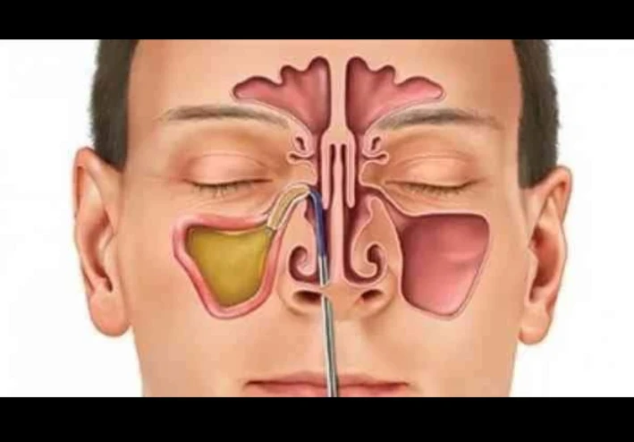 حساسيه الانف والتهابات الجيوب الانفيه وتسببها