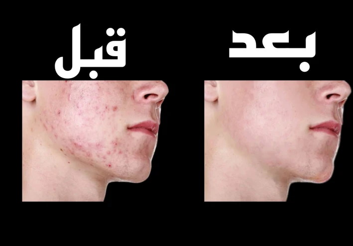 اسرع 5 طرق للحصول علي بشرة صافية وصحية خالية من الحبوب | للرجال والنساء