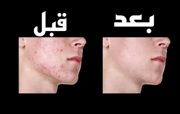 اسرع 5 طرق للحصول علي بشرة صافية وصحية خالية من الحبوب | للرجال والنساء