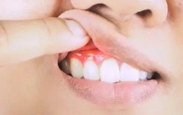 الطرق المتبعة لعلاج التهاب اللثة 