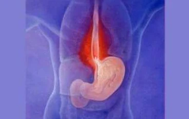 الحموضه وعلاجها ووعراضها وطرق الوقايه منها