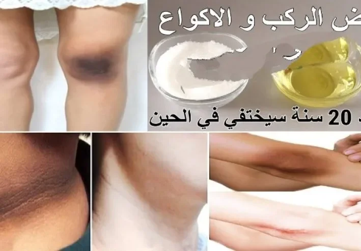 طريقة الاعتناء بمنطقة الكوع والركبة