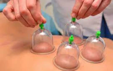 العلاج عن طريق الحجامه وفوائد الحجامه للانسان