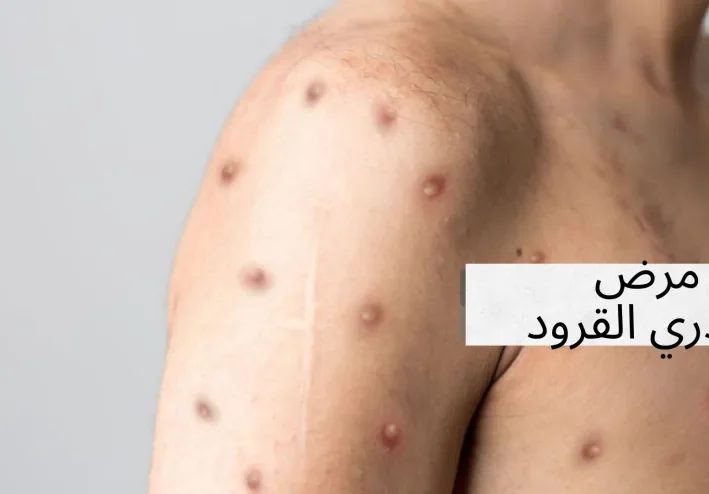 تعرف على مرض جدري القرود الذي انتشر حديثا