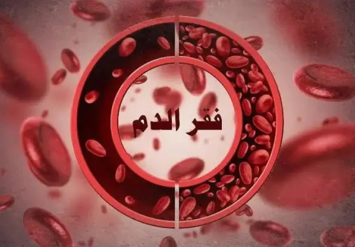 أعراض الانيميا - فقر الدم وكل ما تريد معرفته عنه