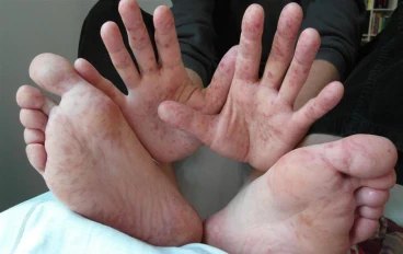 فيرس اليد والقدم والفم hand foot and mouth disease