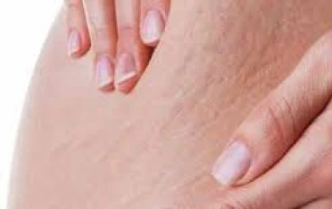 ما هي أسباب السلوليت والخطوط التي تظهر بالجسم وما أنواعها 