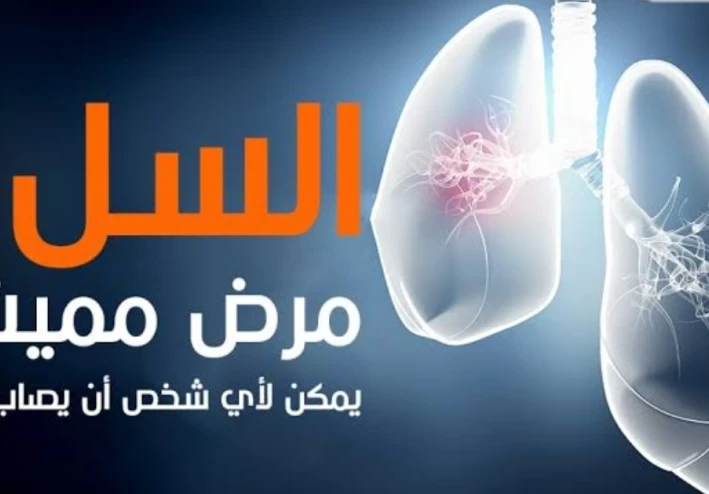 السل وكيف تعالجه