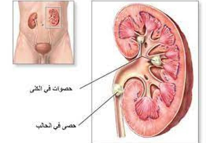 #حصوات الكلي وحصوات الحالب والتخلص منها