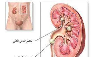 #حصوات الكلي وحصوات الحالب والتخلص منها