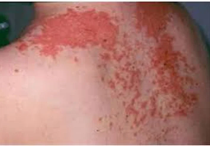 Shingles (Herpes Zoster)
