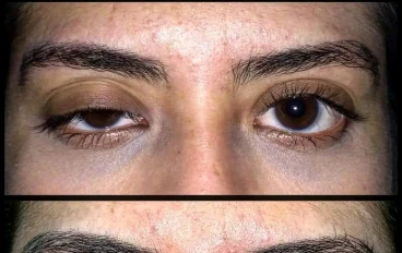 مرض الوهن العضلي الوبيل ٢٠٢٢