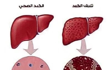 التغذيه السليمه لمريض الكبد المزمن