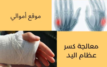 طرق معالجة كسر عظام اليد.