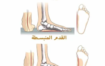 الفلات فوت عند الاطفال