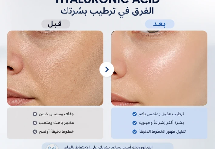مقال الهيالورونيك أسيد