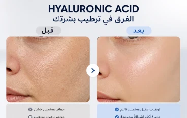 مقال الهيالورونيك أسيد 